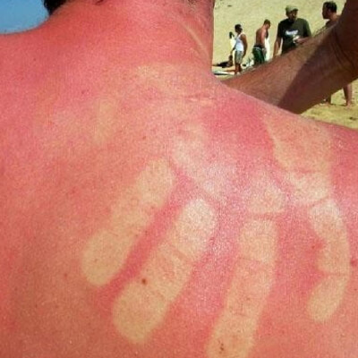Don't ruin your holiday... 5 Most embarrassing sunburn marks